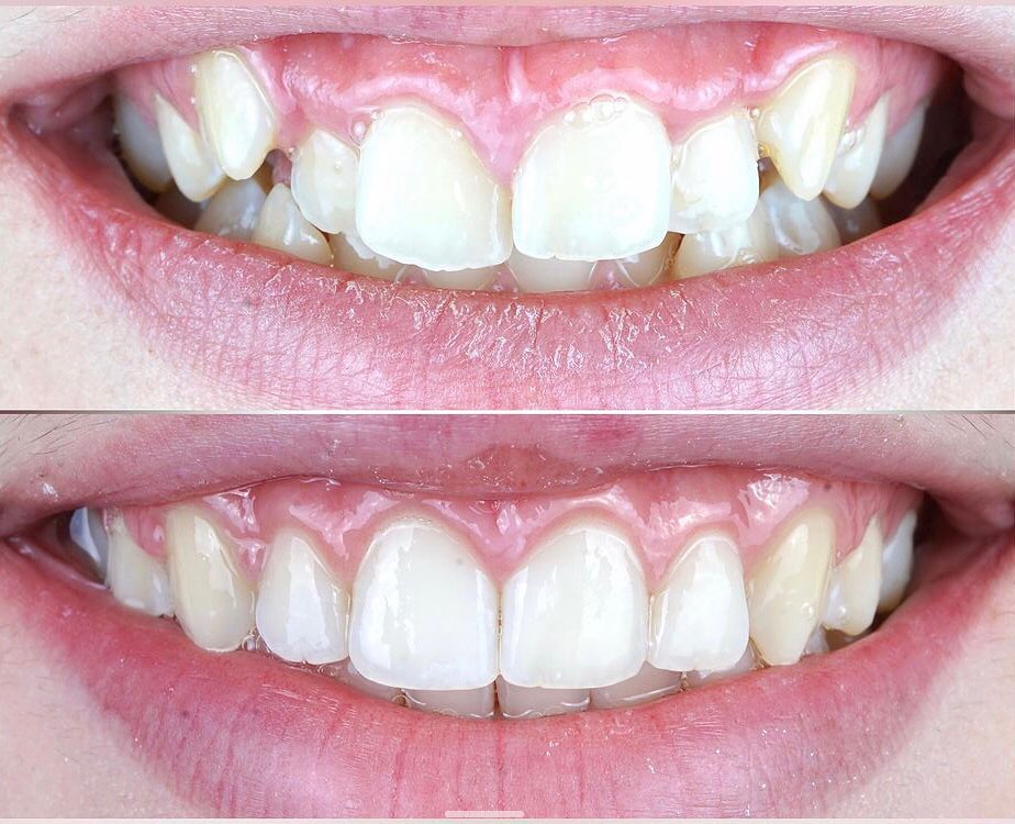 Correção de Sorriso — antes e depois